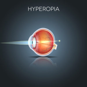 Hyperopia is often called far sighted