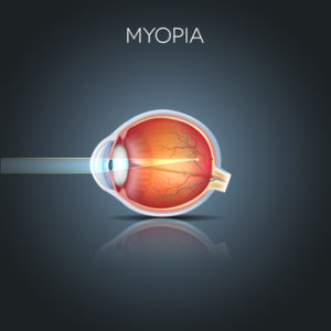 Treat your Myopia at Redmond Eye Clinic